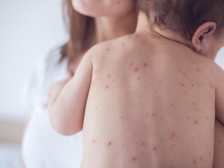 Never Seen Measles? 5 Things to Know