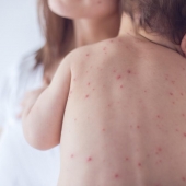 Never Seen Measles? 5 Things to Know